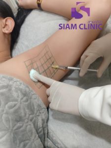 Botox Armpits