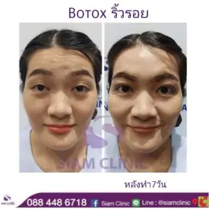 รีวิวโบท็อกซ์