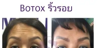 รีวิวโบท็อกซ์