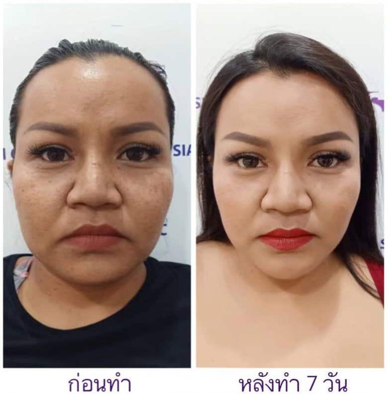 Jaw Reduction Botox Injection