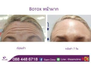 รีวิวโบท็อกซ์