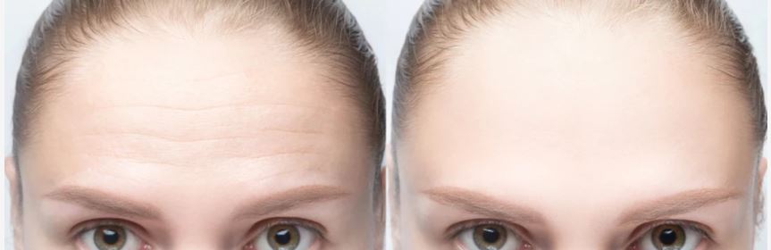 Forehead Filler Injection