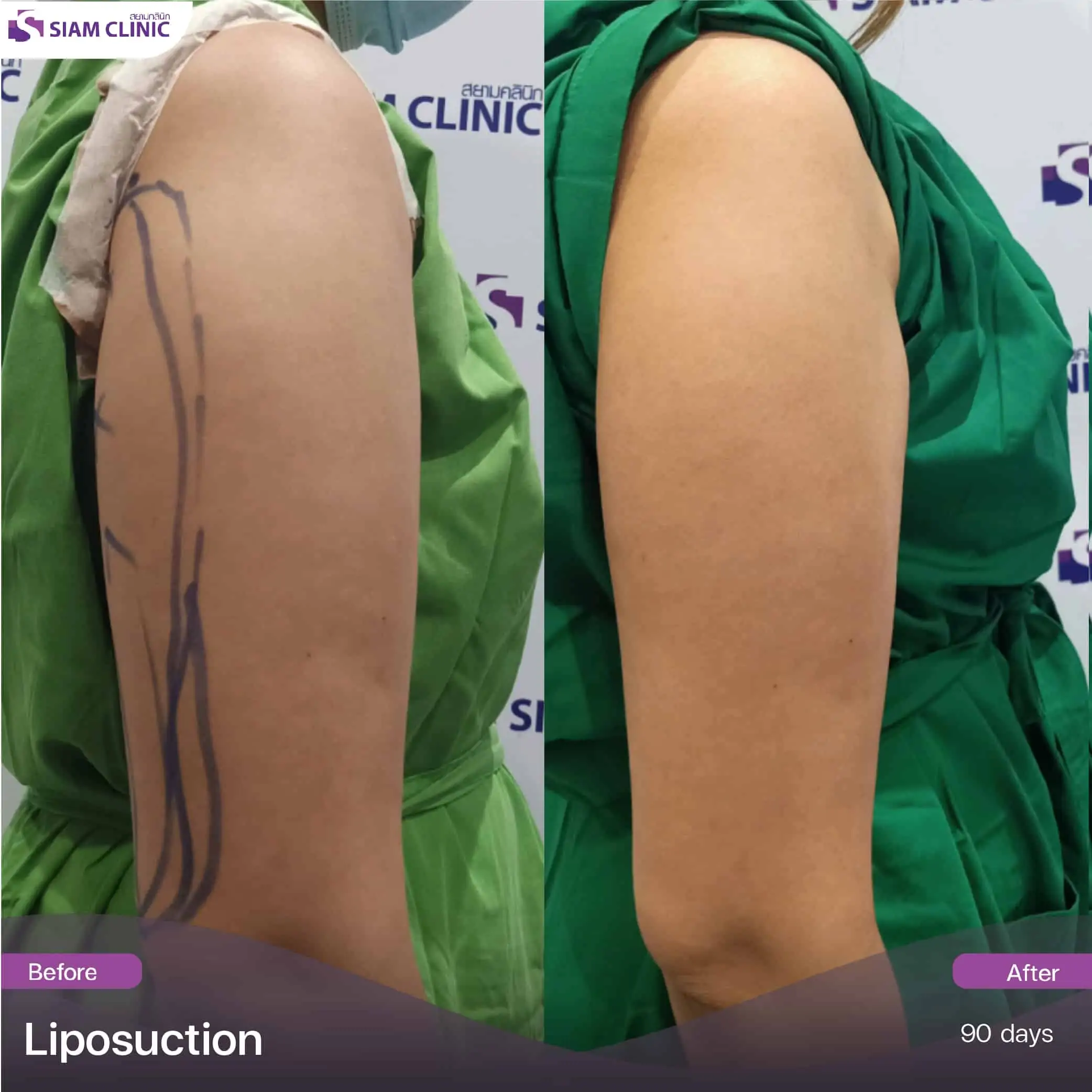 Cavitation - Lux Medicus