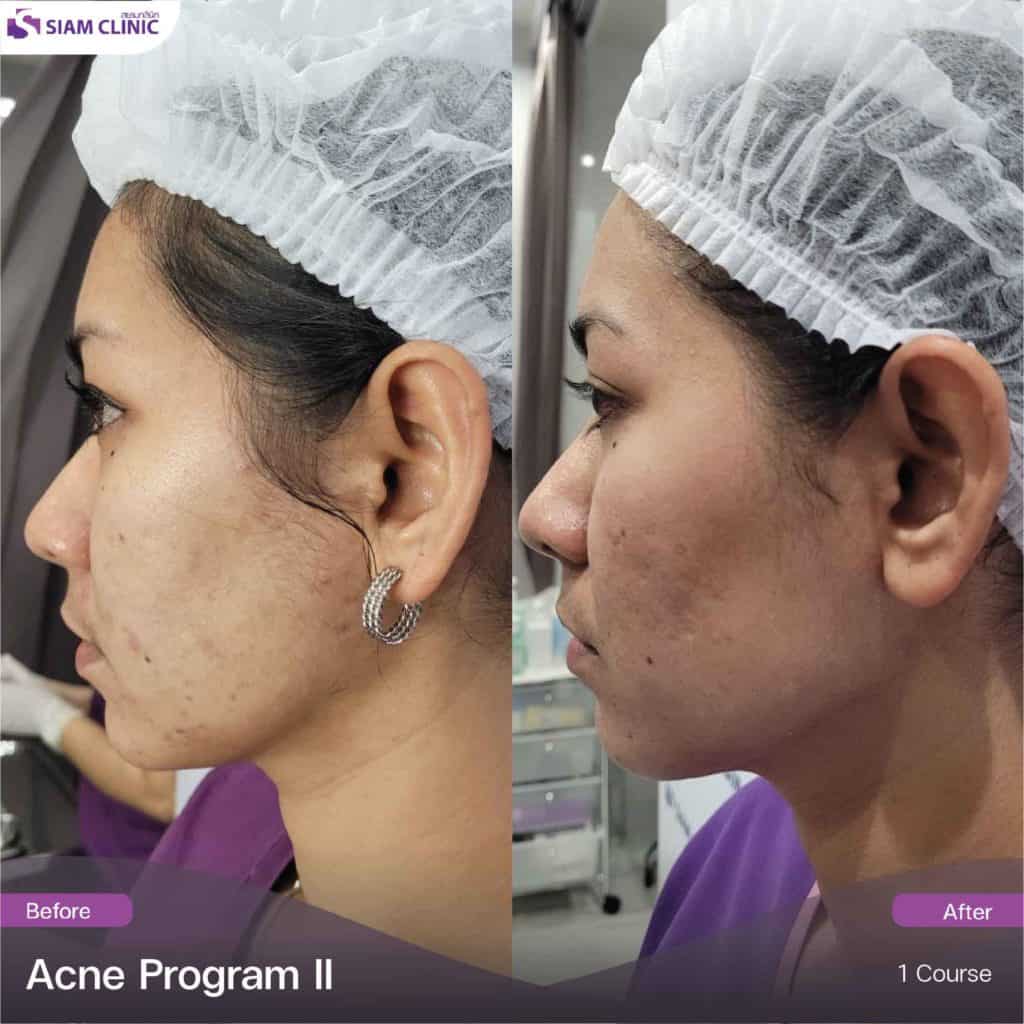 Acne Program Review - Siam Clinic - Aesthetic & Wellness Clinic in Phuket