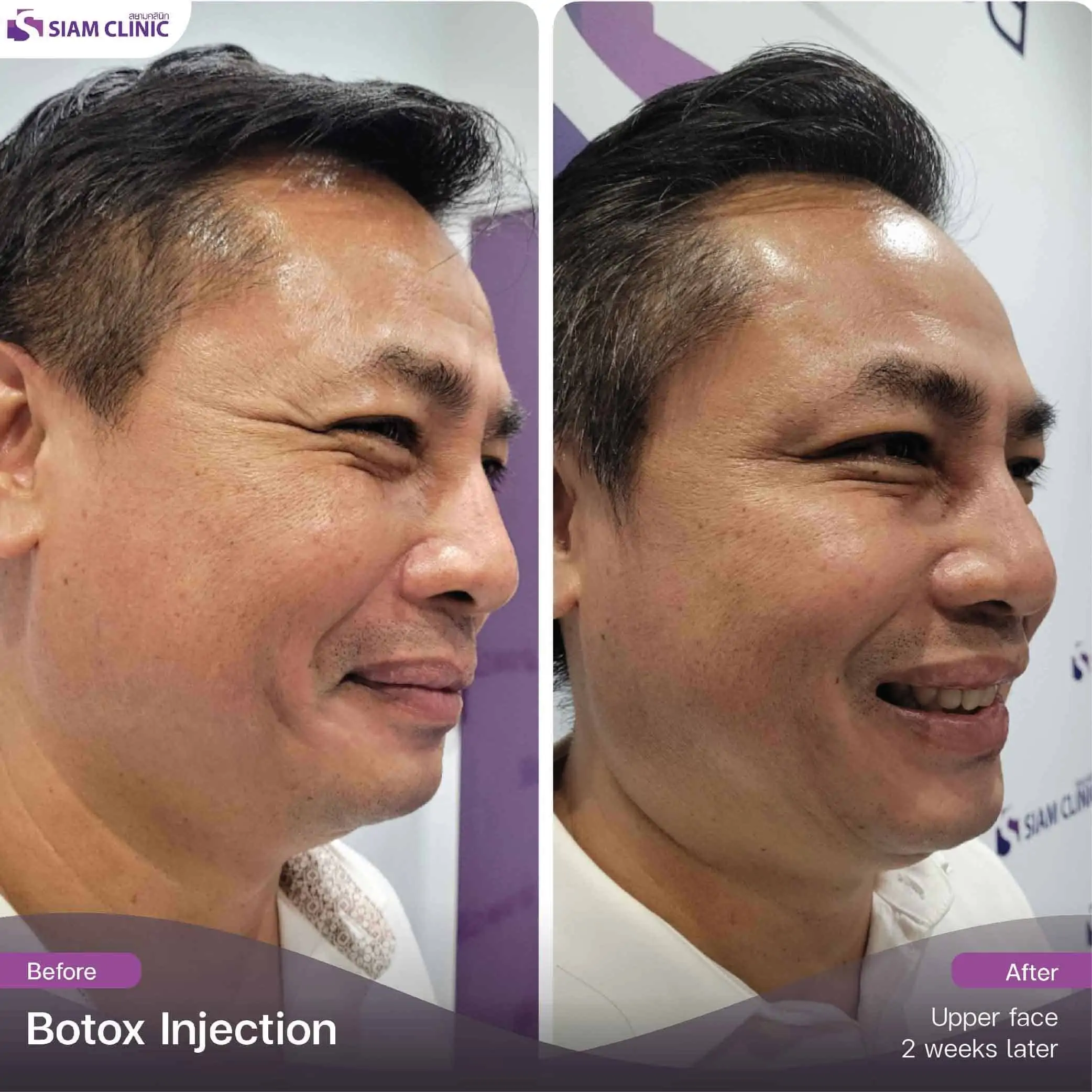 تحتوي هذه الصورة على سمة alt فارغة. اسم ملفه هو botox10.jpg