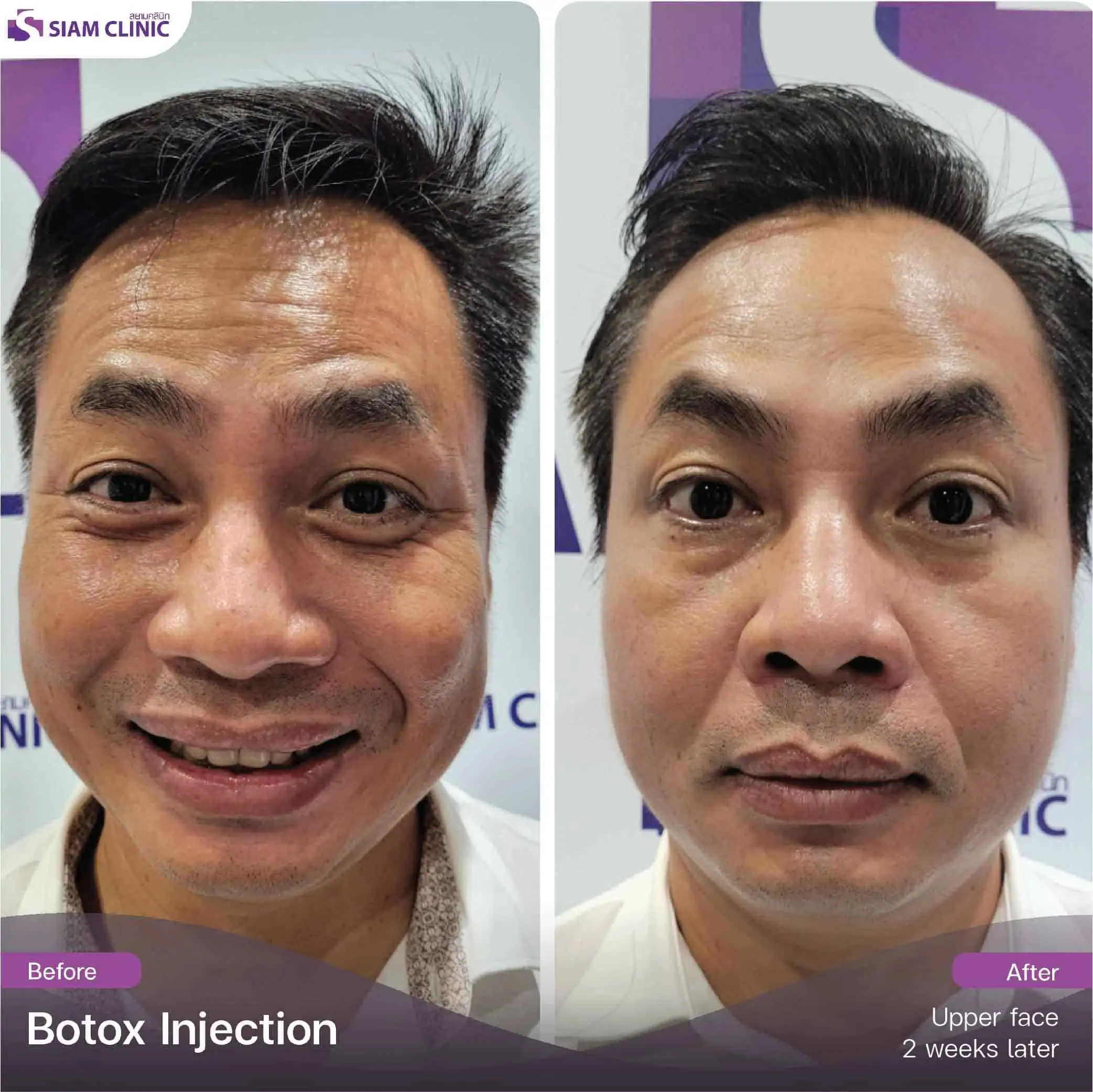 تحتوي هذه الصورة على سمة alt فارغة. اسم ملفه هو botox11.jpg