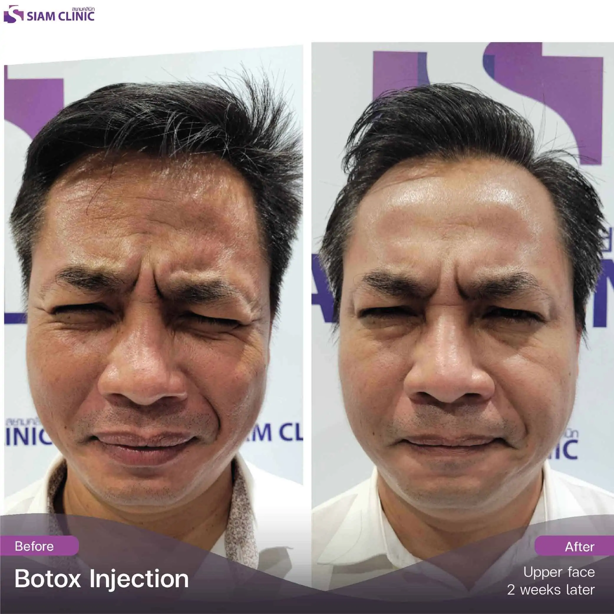 تحتوي هذه الصورة على سمة alt فارغة. اسم ملفه هو botox12.jpg