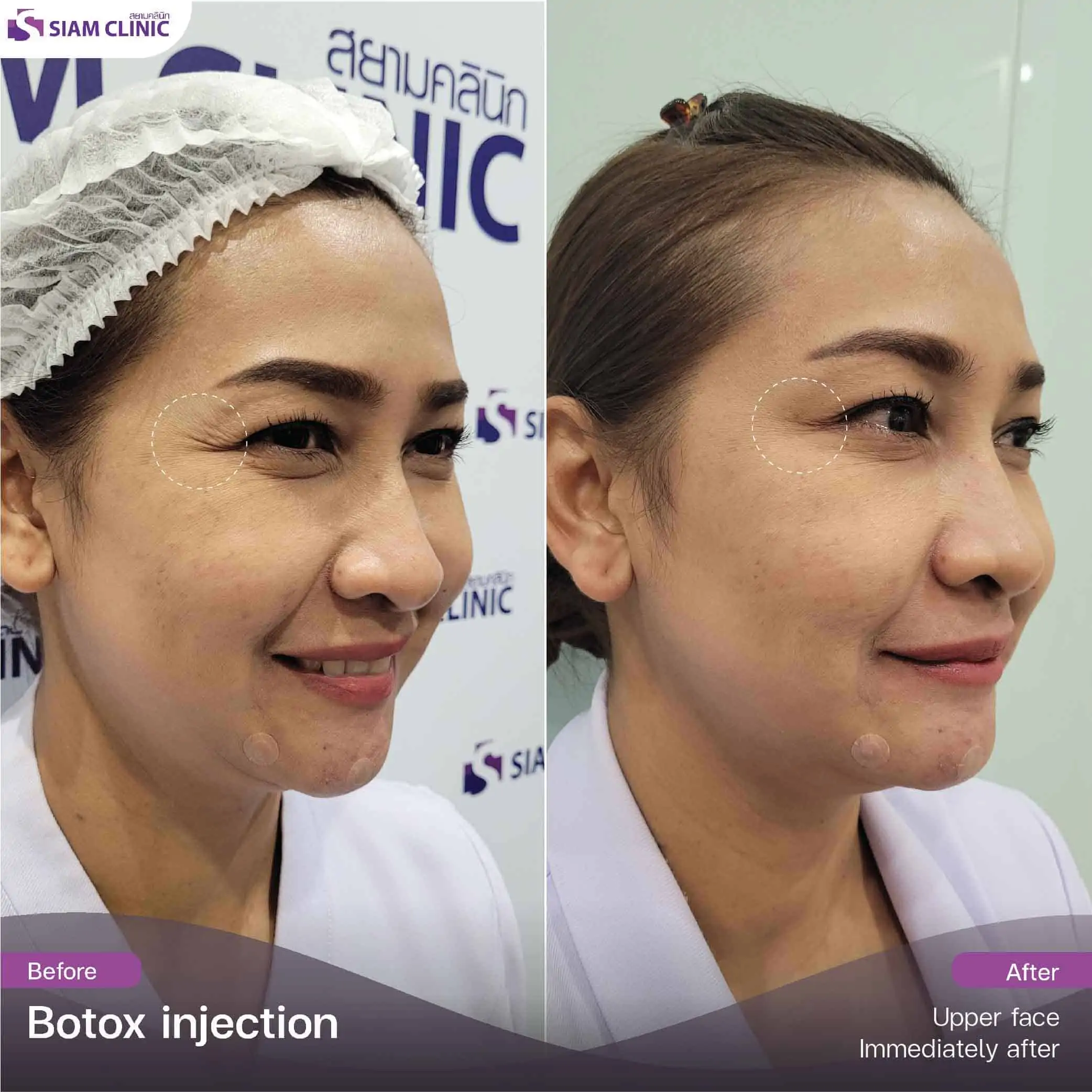 تحتوي هذه الصورة على سمة alt فارغة. اسم ملفه هو botox4.jpg