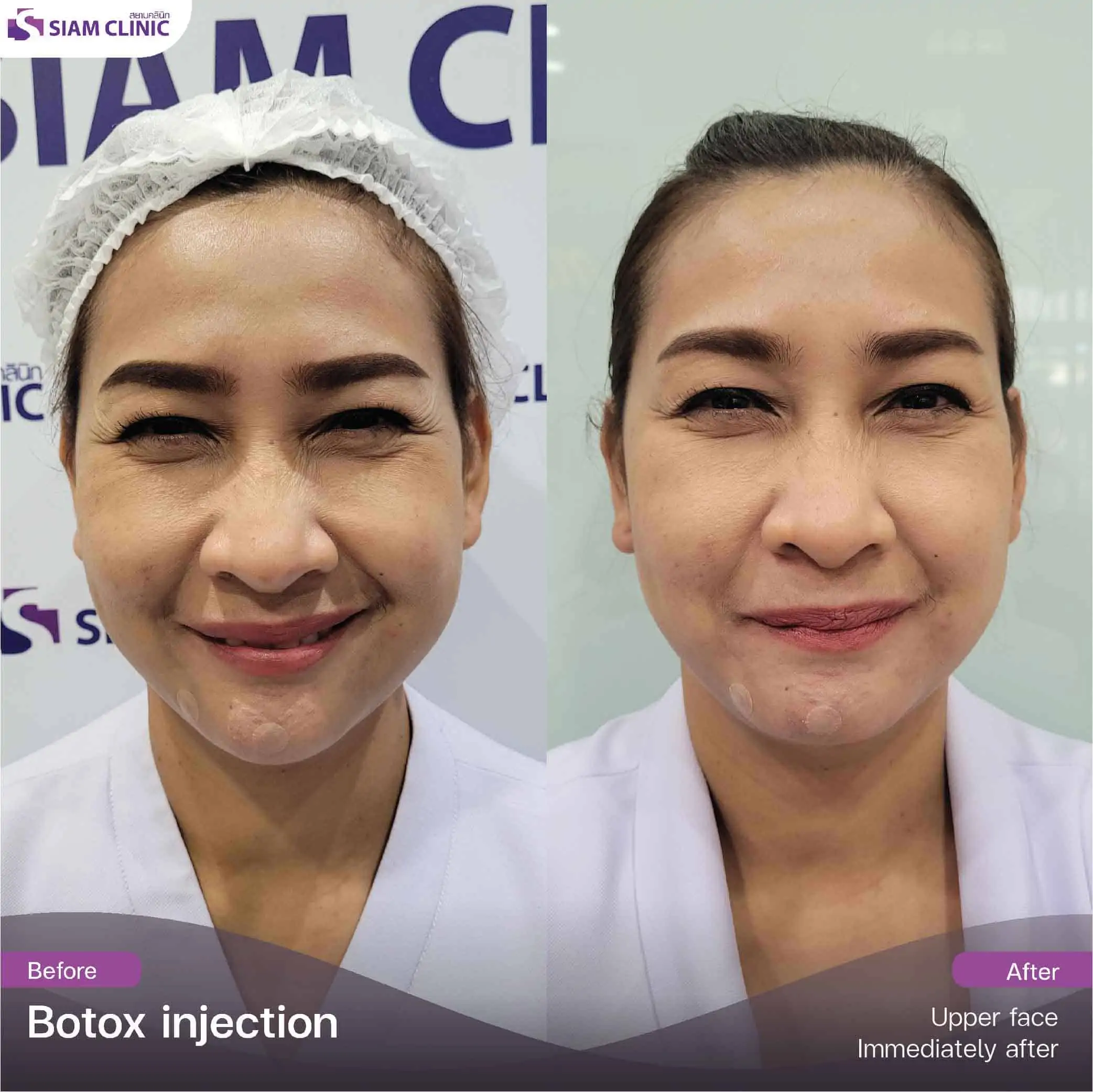 تحتوي هذه الصورة على سمة alt فارغة. اسم ملفه هو botox5.jpg