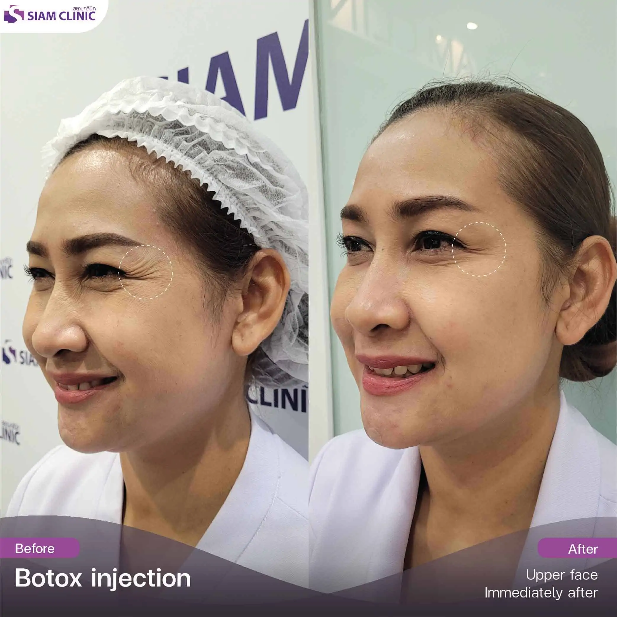 تحتوي هذه الصورة على سمة alt فارغة. اسم ملفه هو botox6.jpg