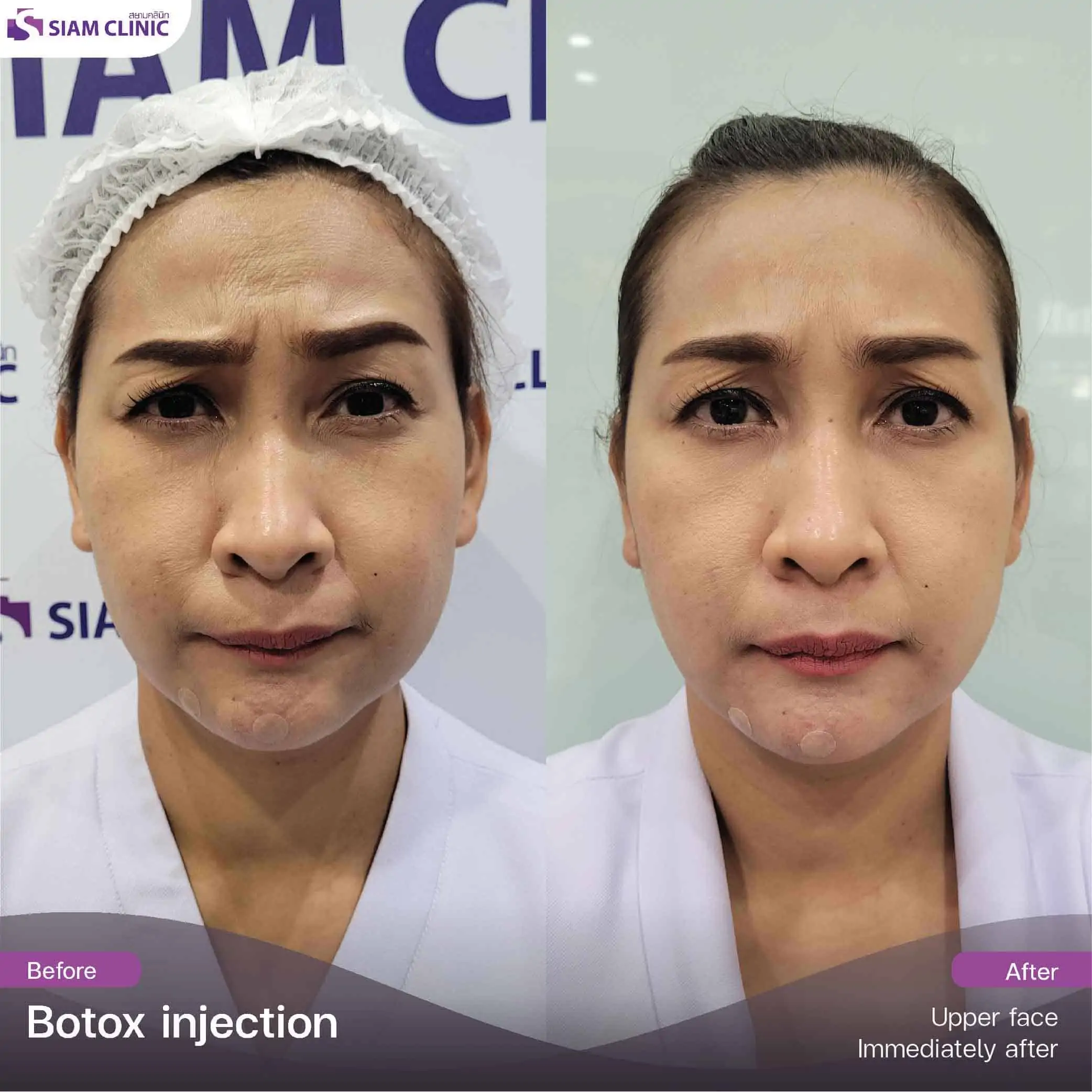 تحتوي هذه الصورة على سمة alt فارغة. اسم ملفه هو botox7.jpg