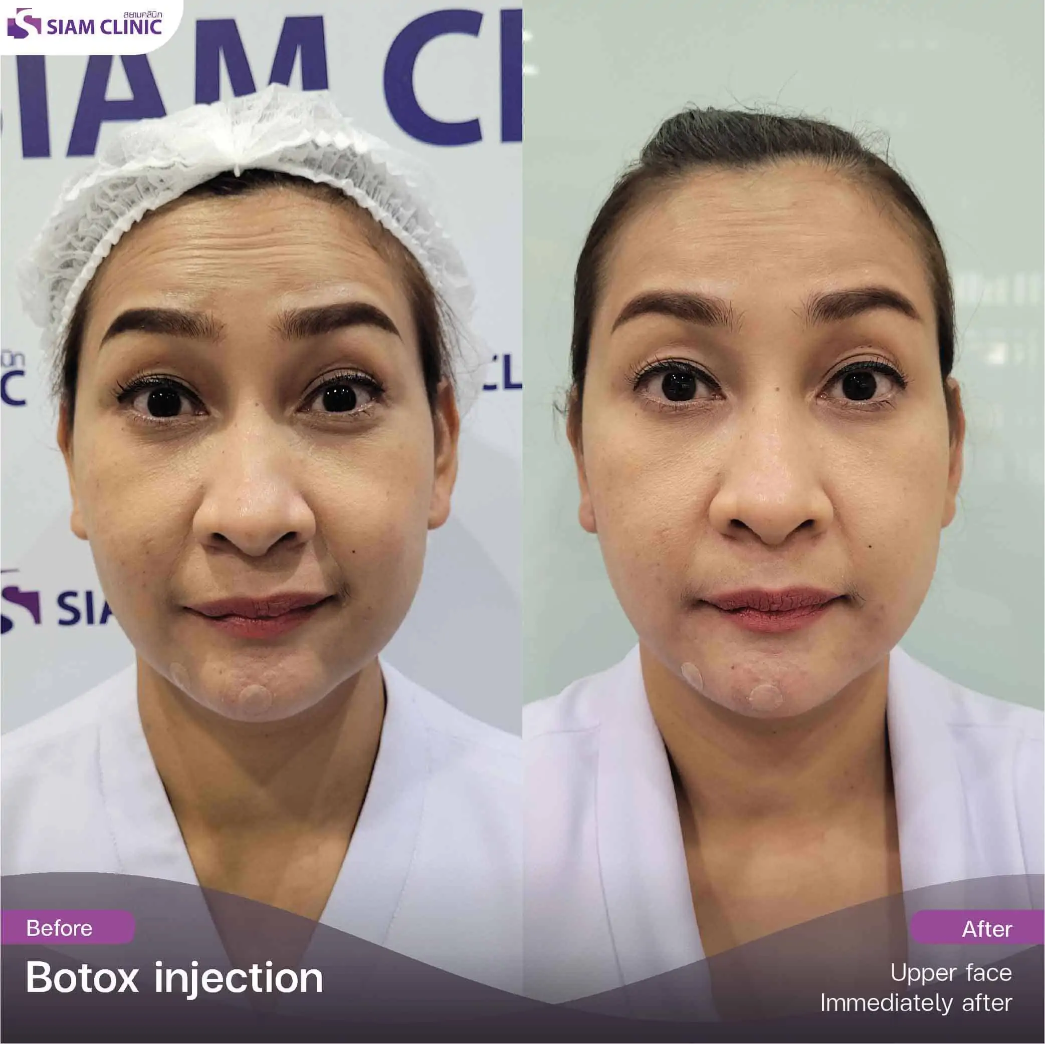 تحتوي هذه الصورة على سمة alt فارغة. اسم ملفه هو botox8.jpg