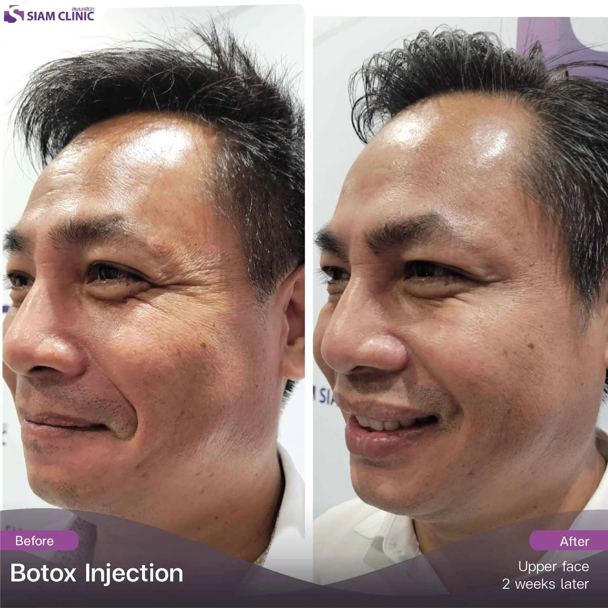 تحتوي هذه الصورة على سمة alt فارغة. اسم ملفه هو botox9.jpg