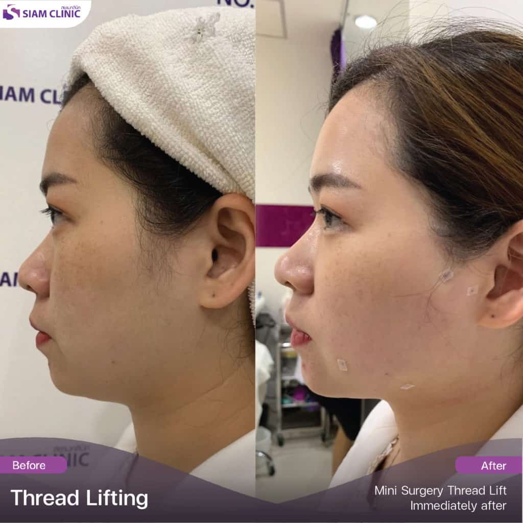 Jawline Thread lifting Siam Clinic Aesthetic & Wellness Clinic in