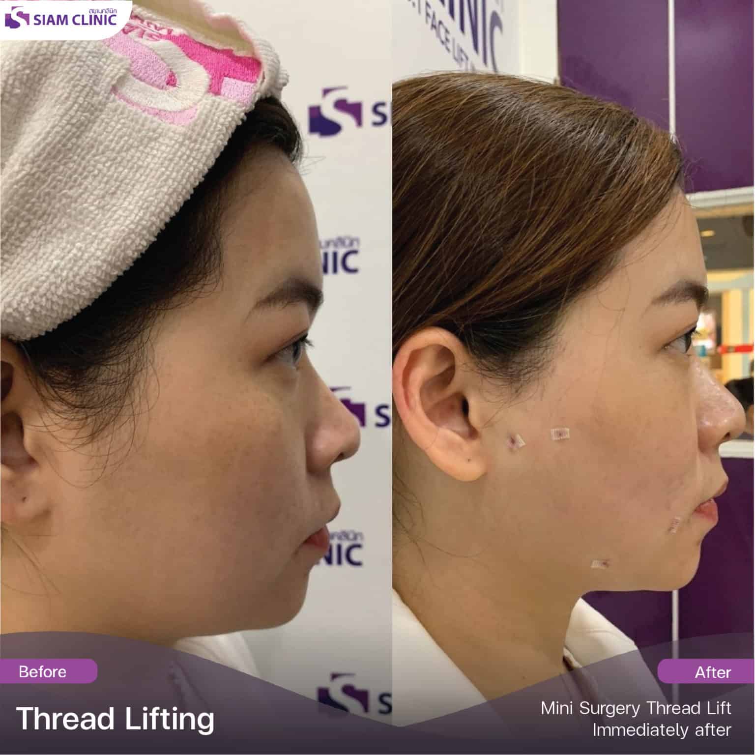 Jawline Thread lifting Siam Clinic Aesthetic & Wellness Clinic in
