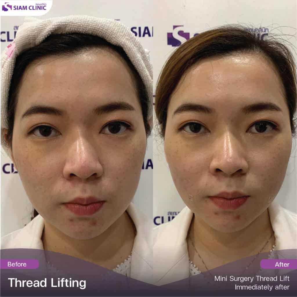 Jawline Thread lifting Siam Clinic Aesthetic & Wellness Clinic in