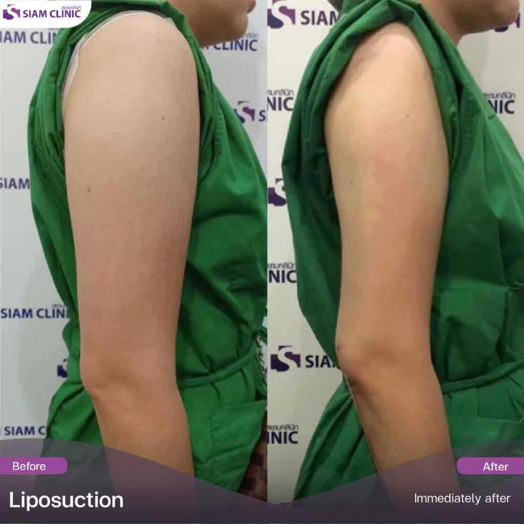 Liposuction Slimming Siam Clinic Aesthetic & Wellness Clinic in Phuket