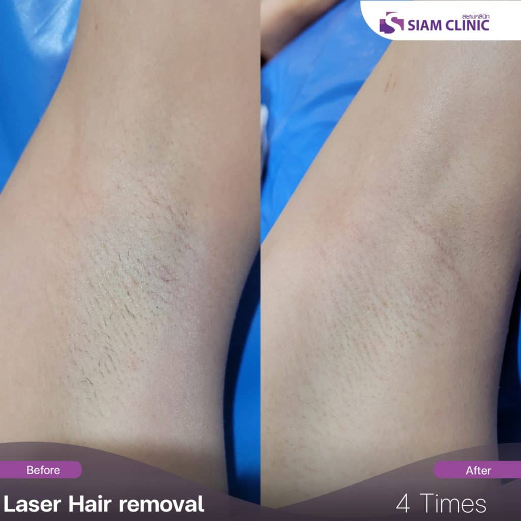 Hair Removal Case Review Siam Clinic Aesthetic & Wellness Clinic in