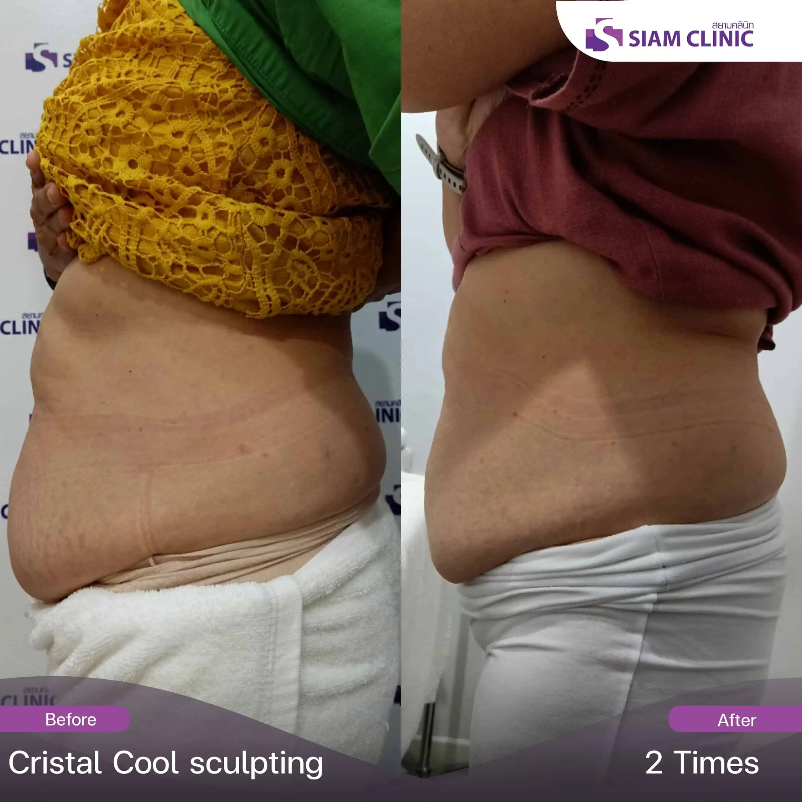 Enhance Cryolipolysis with Hula-Hooping - RT Aesthetics