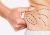 Considering liposuction in Thailand? Discover how this popular procedure works, the benefits, risks, and why Siam Clinic in Phuket is trusted for body contouring.