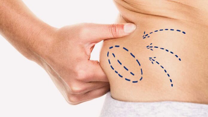Considering liposuction in Thailand? Discover how this popular procedure works, the benefits, risks, and why Siam Clinic in Phuket is trusted for body contouring.